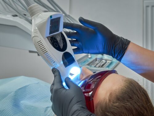 Laserowe wybielanie zębów – na czym polega i czy jest bezpieczne?